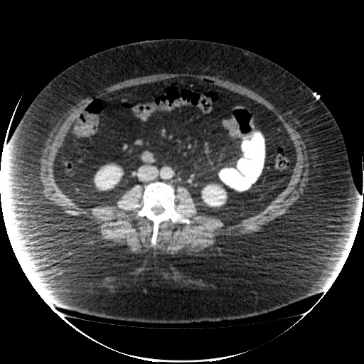 File:Collection due to leak after sleeve gastrectomy (Radiopaedia 55504-61972 A 44).jpg