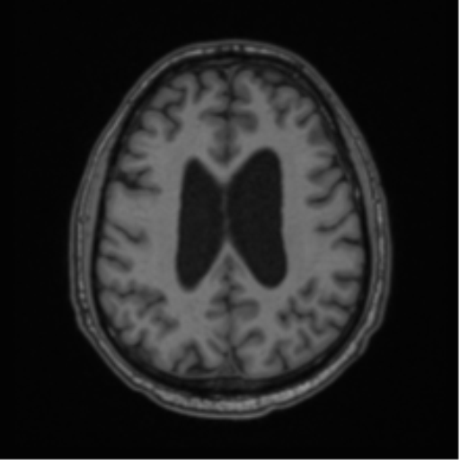 File:Colloid cyst of the third ventricle (Radiopaedia 86571-102662 Axial T1 54).png