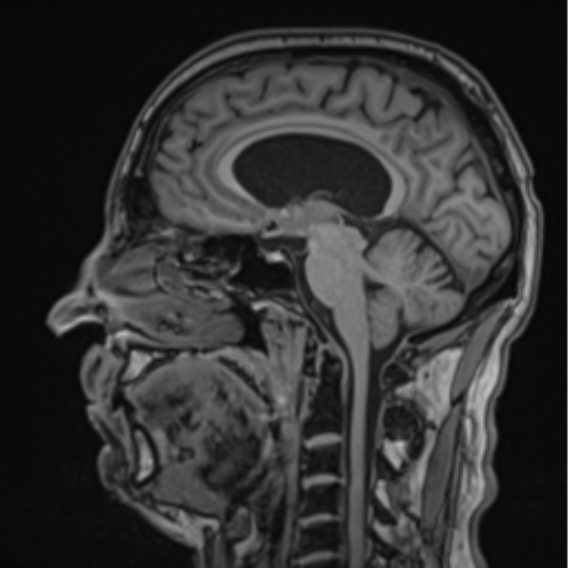File:Colloid cyst of the third ventricle (Radiopaedia 86571-102662 Sagittal T1 37).png
