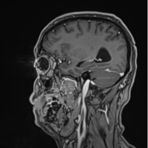 File:Colloid cyst of the third ventricle (Radiopaedia 86571-102662 Sagittal T1 C+ 56).png