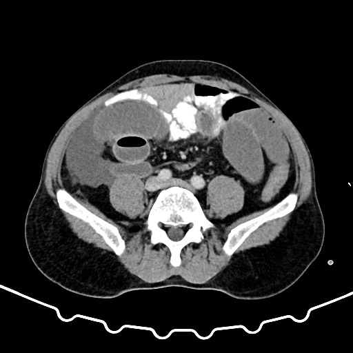 Colocolic intussusception due to large lipoma (Radiopaedia 68773-78482 A 126).jpg
