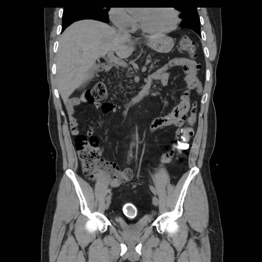 File:Colocutaneous fistula in Crohn's disease (Radiopaedia 29586-30093 E 16).jpg