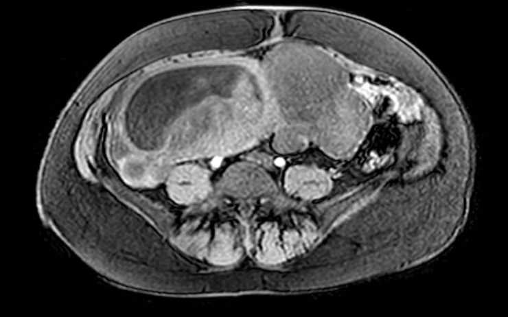 Colon adenocarcinoma with Krukenberg tumors, advanced pregnancy (Radiopaedia 67279-76645 A 33).jpg