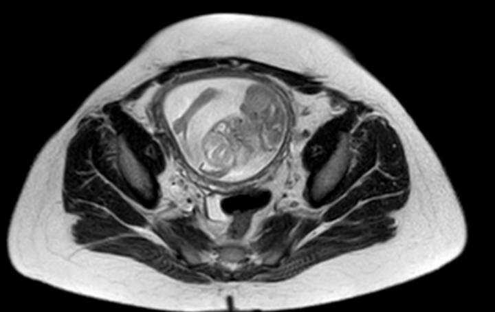 Colon adenocarcinoma with Krukenberg tumors, advanced pregnancy (Radiopaedia 67279-76645 Axial T2 16).jpg