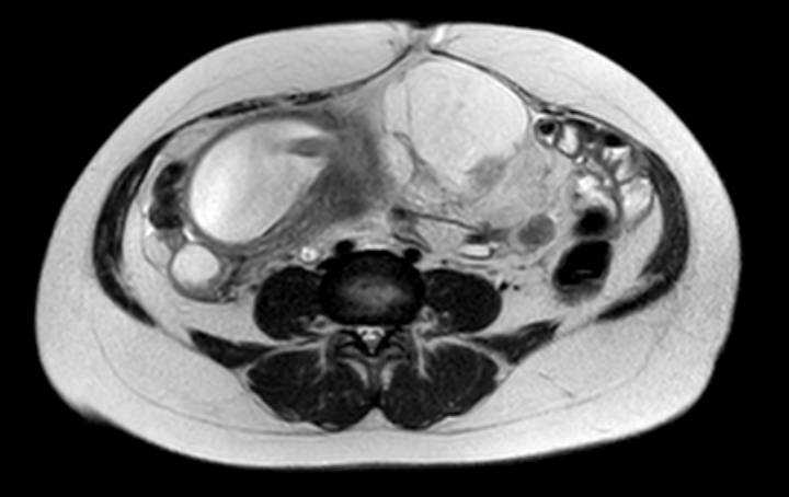 Colon adenocarcinoma with Krukenberg tumors, advanced pregnancy (Radiopaedia 67279-76645 Axial T2 34).jpg