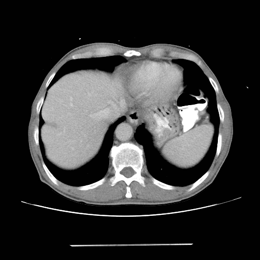 Colon cancer with calcified liver metastasis (Radiopaedia 74423-85307 A 12).jpg