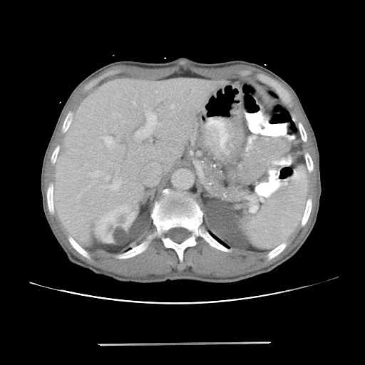 Colon cancer with calcified liver metastasis (Radiopaedia 74423-85307 A 19).jpg