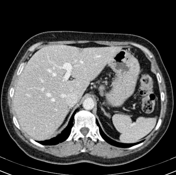 Colon carcinoma with hepatic metastases (Radiopaedia 29477-29961 A 25).jpg