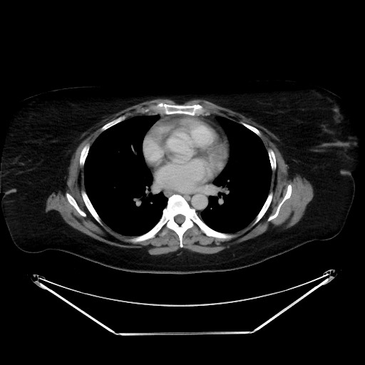File:Colonic intussusception due to adenocarcinoma (Radiopaedia 86828-102987 A 1).jpg