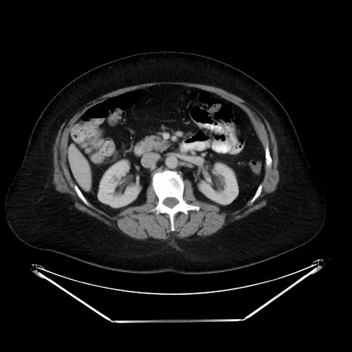 File:Colonic intussusception due to adenocarcinoma (Radiopaedia 86828-102987 A 62).jpg