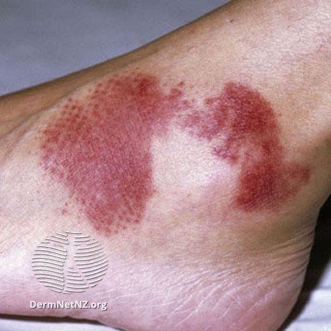 File:Injury (DermNet NZ vascular-s-purpura2).jpg
