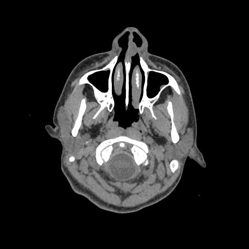 Nasal pyogenic granuloma (lobular capillary hemangioma) (Radiopaedia 85536-101244 Axial non-contrast 16).jpg