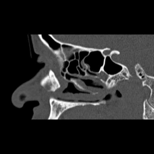 Nasal septal perforation (Radiopaedia 25030-25289 Sagittal bone window 13).jpg
