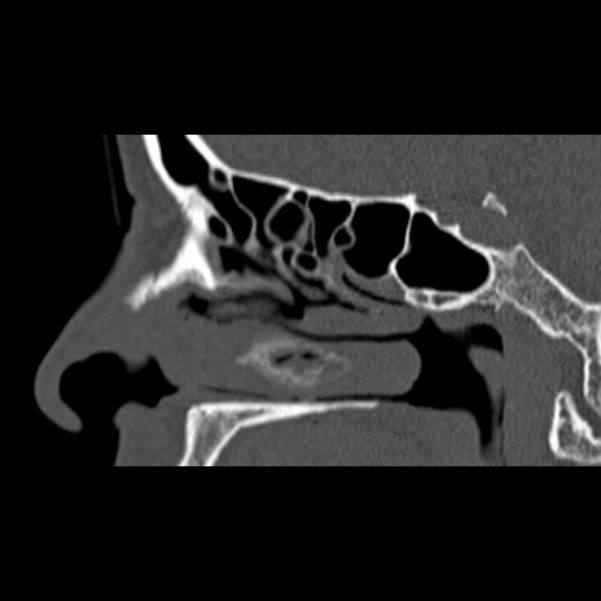 Nasal septal perforation (Radiopaedia 25030-25289 Sagittal bone window 18).jpg