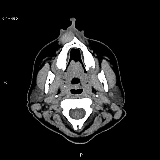 File:Nasolabial cyst (Radiopaedia 75125-86194 Axial non-contrast 28).jpg