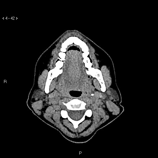 Nasolabial cyst (Radiopaedia 75125-86194 Axial non-contrast 4).jpg