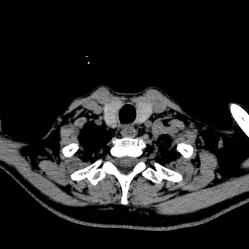 File:Nasopharyngeal carcinoma - infiltrating the clivus (Radiopaedia 62583-70875 Axial non-contrast 62).jpg