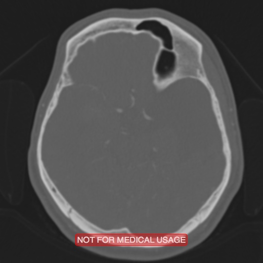 File:Nasopharyngeal carcinoma recurrence - skull base destruction (Radiopaedia 29107-29490 Axial bone window 63).jpg
