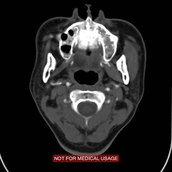 File:Nasopharyngeal carcinoma recurrence - skull base destruction (Radiopaedia 29107-29491 A 14).jpg