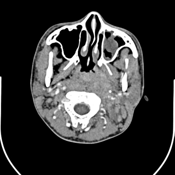 Nasopharyngeal carcinoma with skull base invasion (Radiopaedia 53415-59705 A 61).jpg
