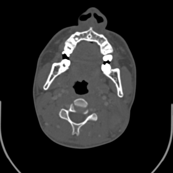 Nasopharyngeal carcinoma with skull base invasion (Radiopaedia 53415-59705 Axial bone window 96).jpg