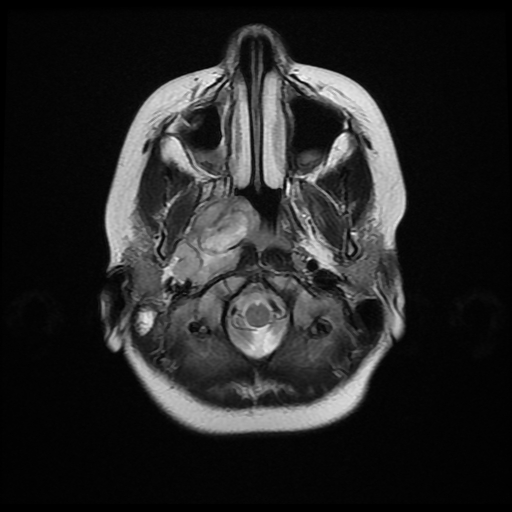 File:Nasopharyngeal rhabdomyosarcoma (Radiopaedia 23417-23486 Axial T2 3).jpg