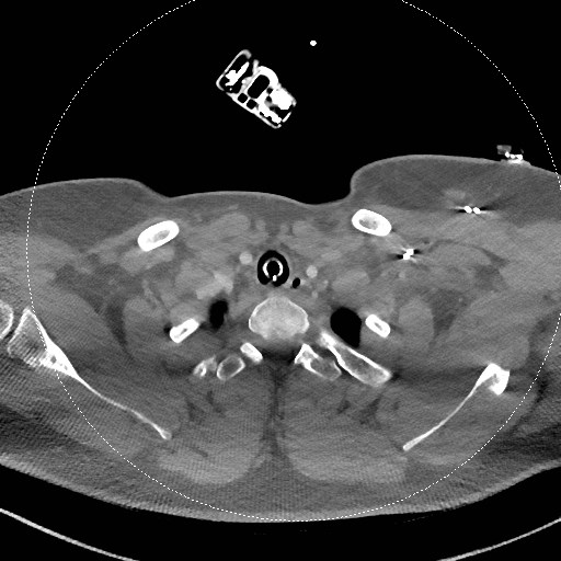 File:Neck CT angiogram (intraosseous vascular access) (Radiopaedia 55481-61945 B 104).jpg