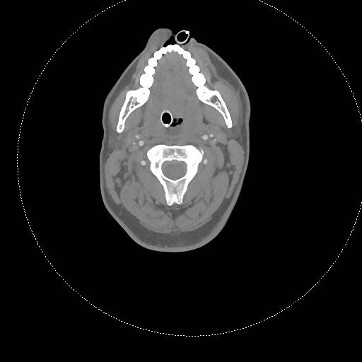 Neck CT angiogram (intraosseous vascular access) (Radiopaedia 55481-61945 B 215).jpg