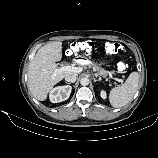 Necrotizing pancreatitis (Radiopaedia 87796-104249 A 18).jpg