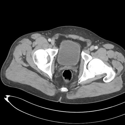 File:Necrotizing pancreatitis with acute necrotic collections (Radiopaedia 38829-41012 B 81).png