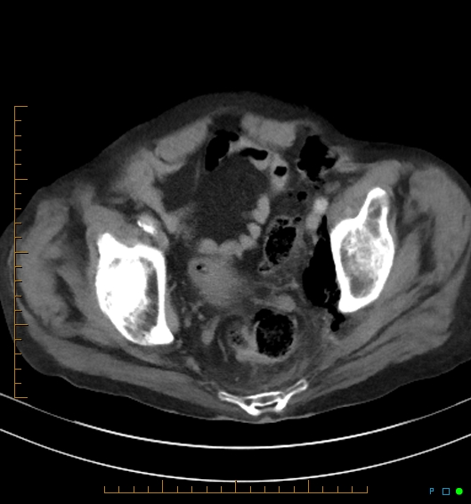 Necrotzing fasciitis due to a perforated adenocarcinoma of the splenic flexure (Radiopaedia 46930-51455 A 56).jpg
