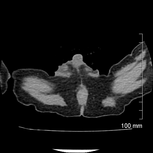 File:Neonatal neuroblastoma (Radiopaedia 56651-63438 Axial non-contrast 93).jpg