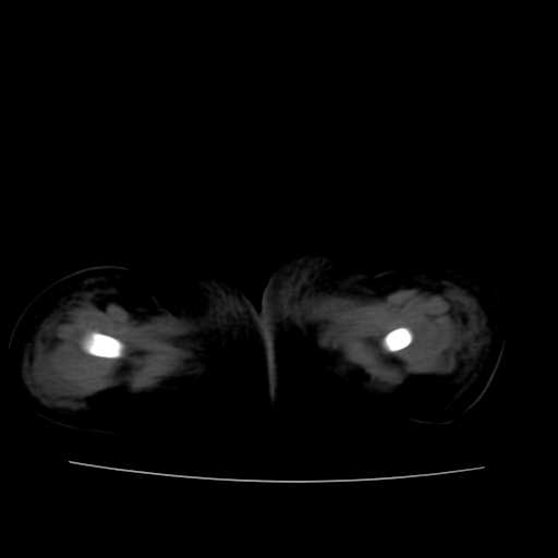 File:Neuroblastoma (Radiopaedia 20876-20799 Axial non-contrast 29).jpg