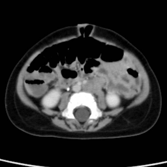 Neuroblastoma with skull metastases (Radiopaedia 30326-30960 C 37).jpg