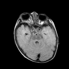 File:Neurofibromatosis type 1 (Radiopaedia 30089-30671 Axial FLAIR 8).jpg
