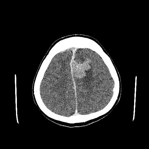 File:Neurofibromatosis type 2 (Radiopaedia 25389-25637 Axial C+ 78).jpg
