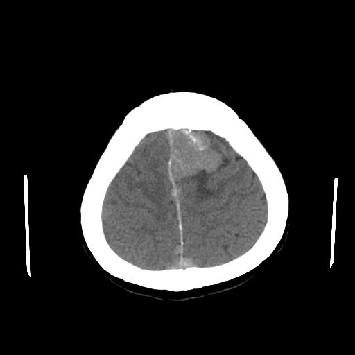 File:Neurofibromatosis type 2 (Radiopaedia 25389-25637 Axial non-contrast 23).jpg