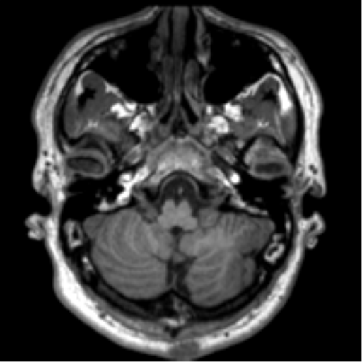 File:Neurofibromatosis type 2 (Radiopaedia 44936-48838 Axial T1 19).png