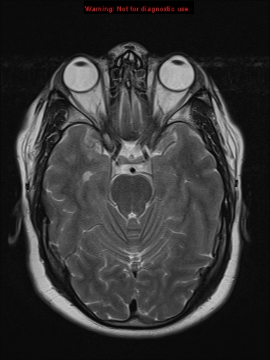File:Neuroglial cyst (Radiopaedia 10713-11184 Axial T2 15).jpg