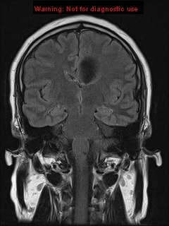 File:Neuroglial cyst (Radiopaedia 10713-11184 Coronal FLAIR 13).jpg