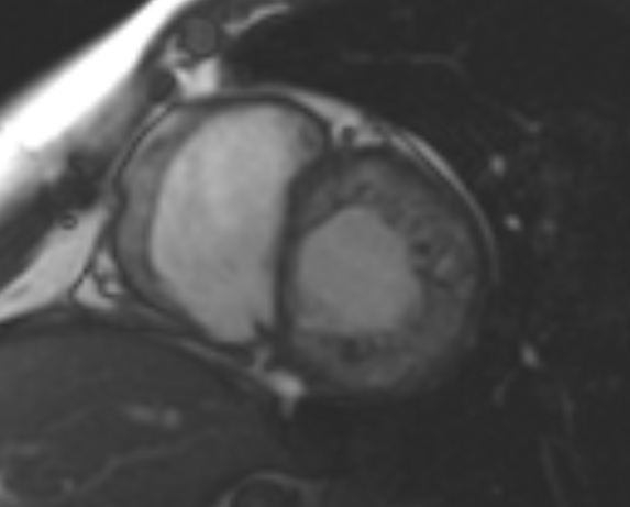 File:Non-compaction of the left ventricle (Radiopaedia 69436-79314 Short axis cine 141).jpg