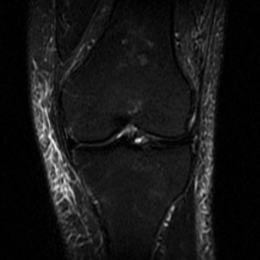 File:Non-displaced patella fracture (Radiopaedia 15932-15582 Coronal STIR 12).jpg