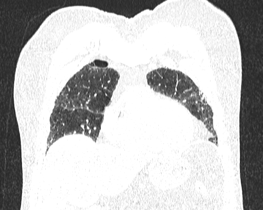Non-specific interstitial pneumonia (NSIP) (Radiopaedia 68599-78228 Coronal lung window 20).jpg