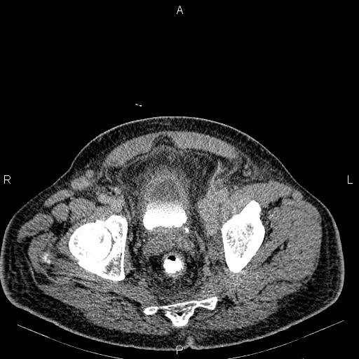 Non Hodgkin lymphoma in a patient with ankylosing spondylitis (Radiopaedia 84323-99621 Axial C+ delayed 73).jpg