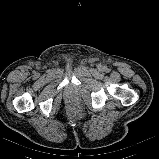 File:Non Hodgkin lymphoma in a patient with ankylosing spondylitis (Radiopaedia 84323-99621 Axial non-contrast 64).jpg