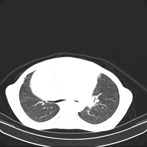 File:Non hodgkin lymphoma of the mediastinum (Radiopaedia 20814-20729 Axial lung window 22).jpg