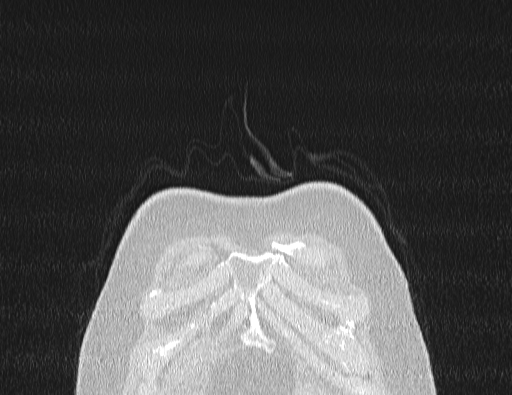 Non specific interstitial pneumonia (NSIP) (Radiopaedia 89725-106798 Coronal lung window 3).jpg