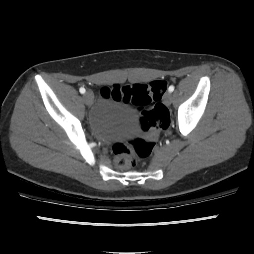 File:Normal CT angiogram of pelvis (Radiopaedia 45390-49430 A 38).jpg