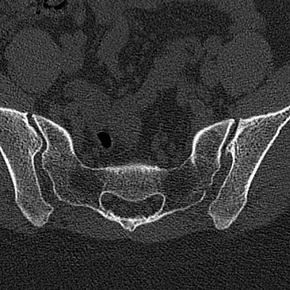 File:Normal CT lumbar spine (Radiopaedia 53981-60118 Axial bone window 75).jpg