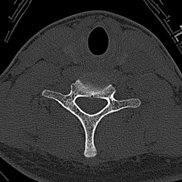 Normal CT of the cervical spine (Radiopaedia 53322-59305 Axial bone window 201).jpg